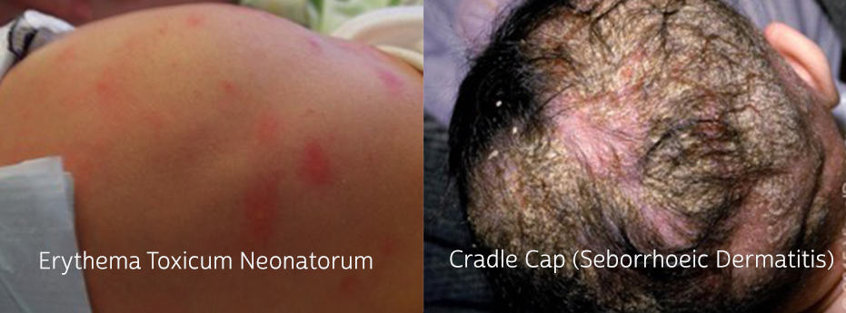 Common Newborn Skin Conditions